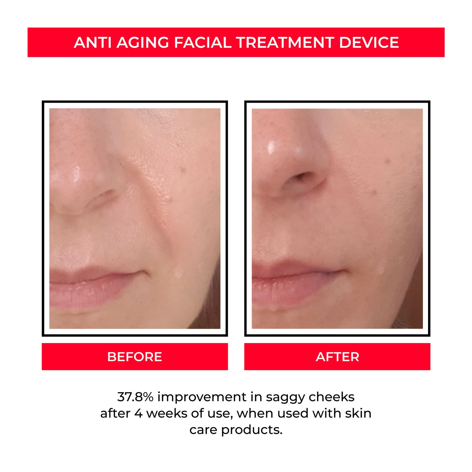 Beau EMS Eye Lifting