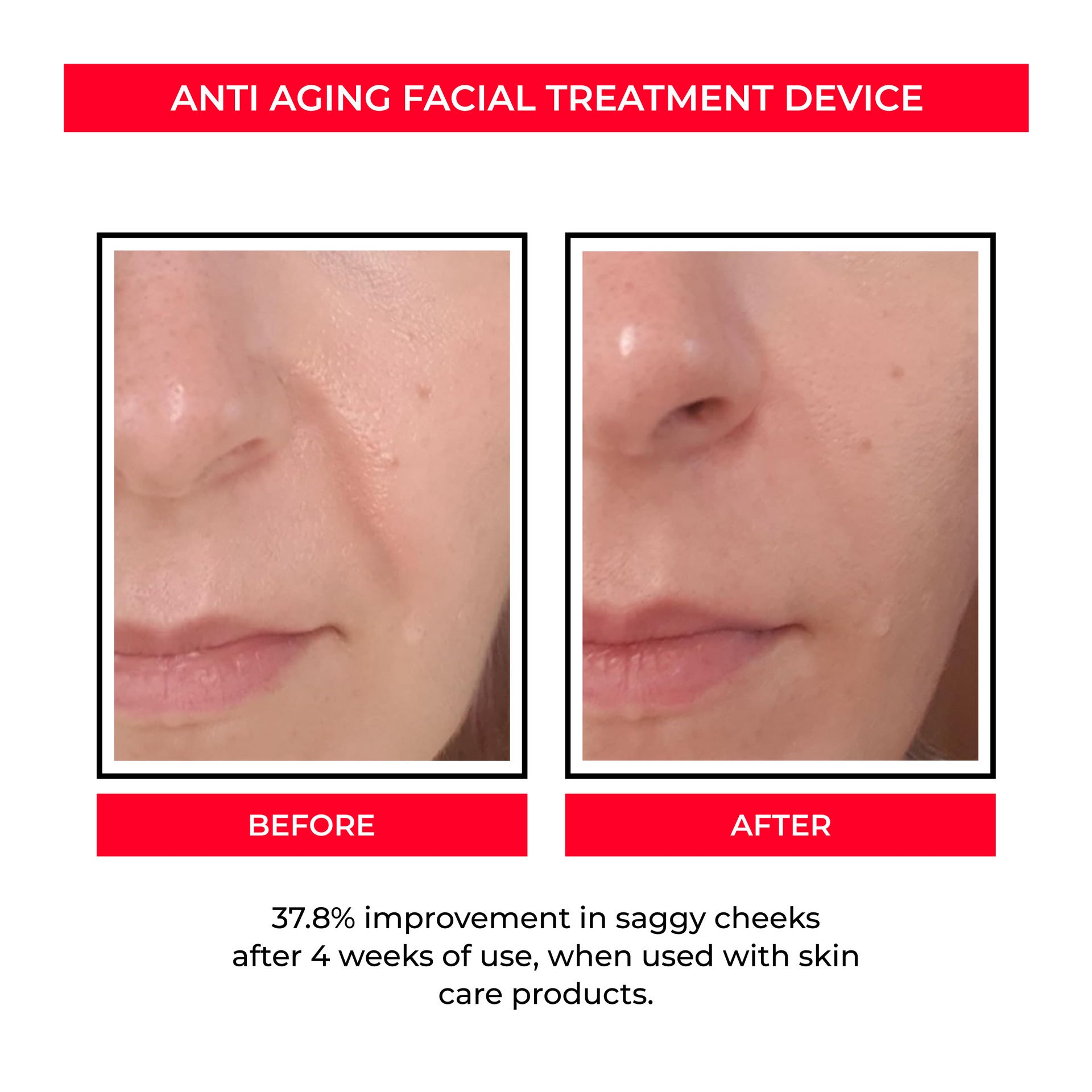 Beau EMS Eye Lifting